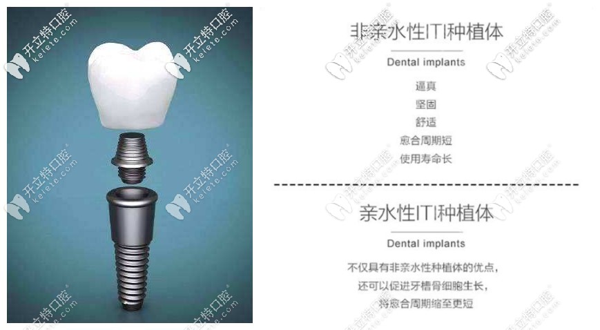 瑞士ITI親水性和非親水性優(yōu)勢(shì)圖