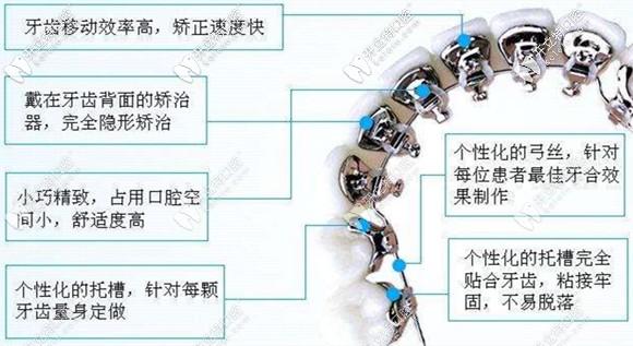 關(guān)于舌側(cè)隱形矯正的優(yōu)點(diǎn)