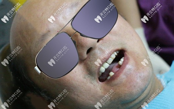 種植牙過程中的感受