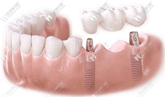 想讓種植牙為我們長期服務(wù)離不開自己的細(xì)心呵護(hù)