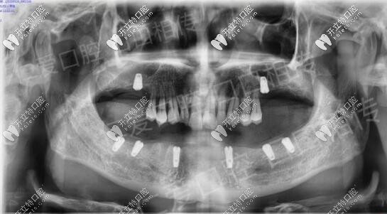 <!--<i data=20240703-sp></i>-->口腔醫(yī)院半口ALL-ON-6種植牙<span style=