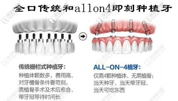 全口傳統(tǒng)種植牙和allon4即刻負(fù)重種植牙