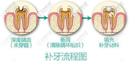 兒童補(bǔ)牙的流程圖