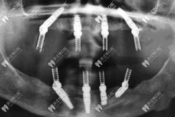 福州allon4全口種植牙價(jià)格