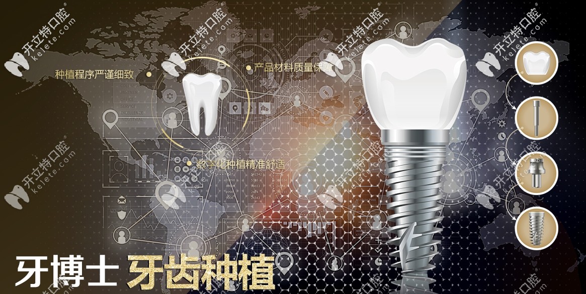 牙博士口腔牙齒種植優(yōu)勢(shì)