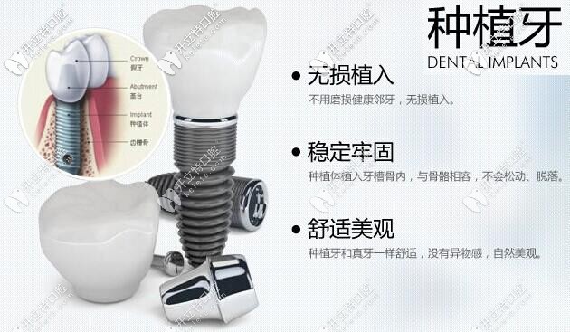 牙博士口腔種植牙價(jià)格