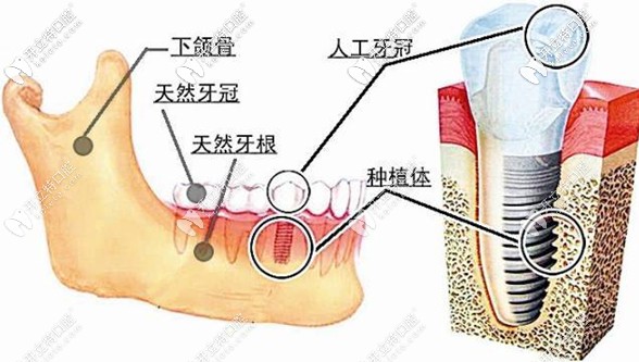 以色列雅定和意大利bb種植系統(tǒng)價格