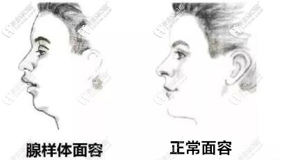 別讓這種面型毀了娃,兒童腺樣體面容戴mrc矯正器能矯正嗎？