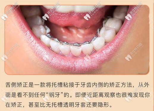 蘇州舌側(cè)隱形牙齒矯正價格