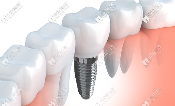 德國和美國種植牙價格