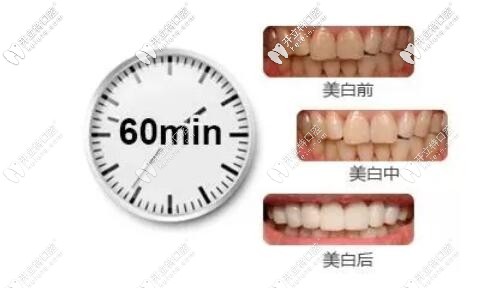 皓齒美白時(shí)間