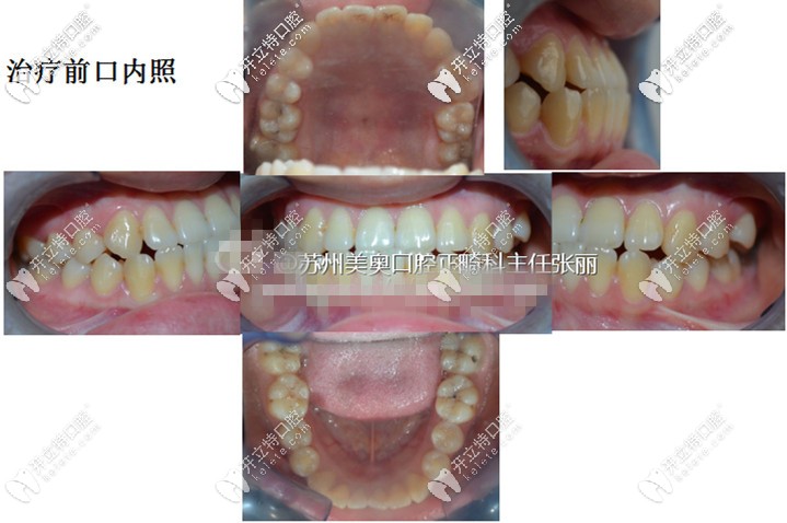 附上治療前的口內(nèi)照——上頜、左側(cè)面和右側(cè)面、下頜