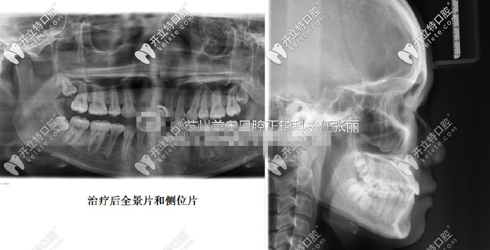 矯正后的側(cè)位片和全景片