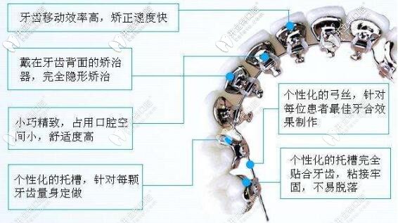 舌側(cè)矯正的優(yōu)勢(shì)