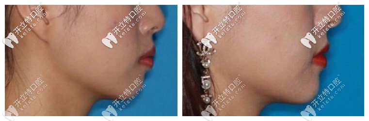 舌側(cè)隱形牙套矯正前后對(duì)比照