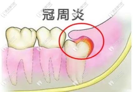 智齒冠周炎圖片