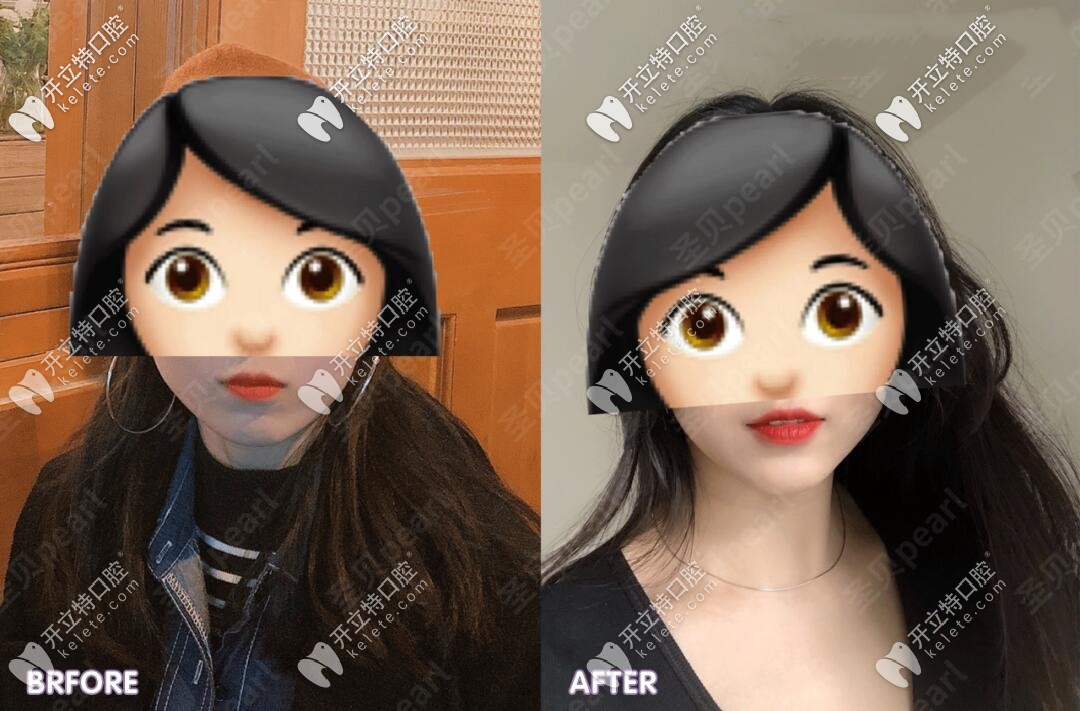 拔智齒前后臉型對(duì)比圖