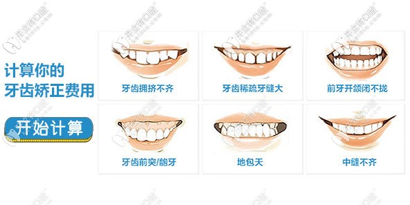嘿!萍鄉(xiāng)牙齒矯正價格表被我挖到啦,固定矯正費用好劃算