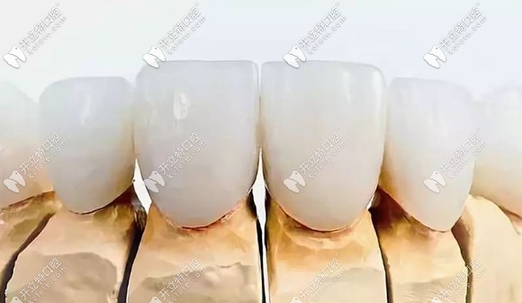 全瓷冠常見(jiàn)品牌及價(jià)格介紹