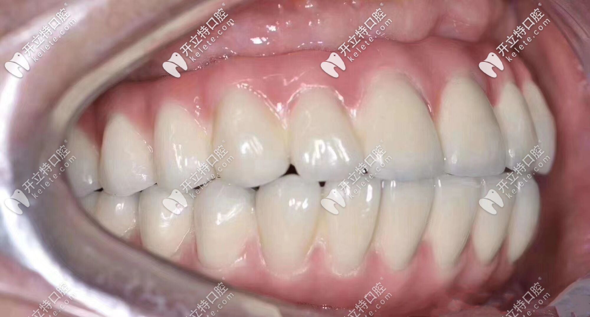 全口即刻種植牙后圖示 全口即刻種植牙后圖示