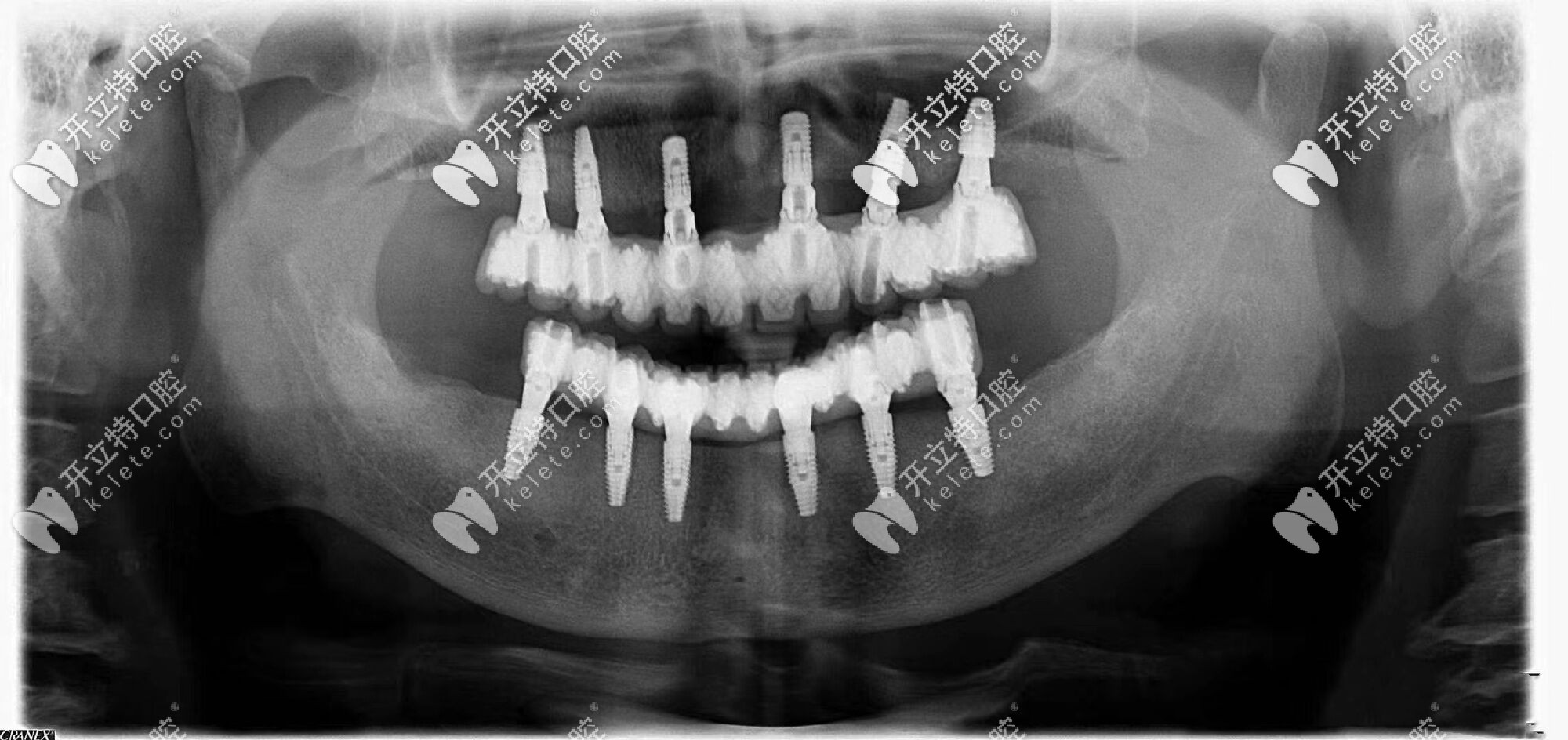 口內(nèi)拍片圖示 口內(nèi)拍片圖示