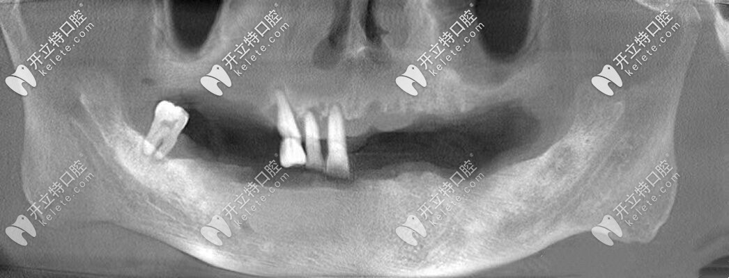 做種植牙之前照片 做種植牙之前照片