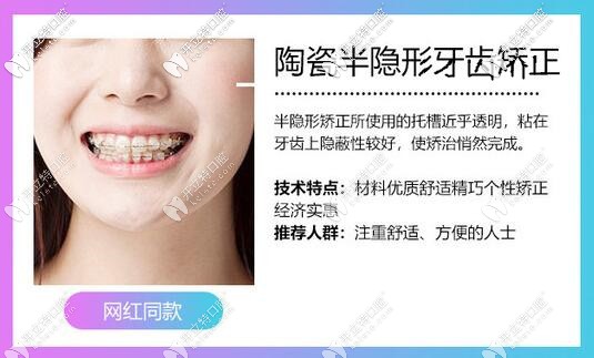 陶瓷半隱形矯正優(yōu)點