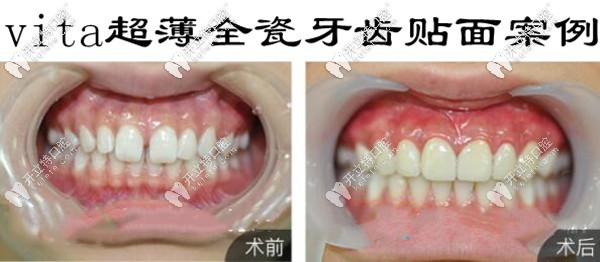德國(guó)vita瓷貼面的效果怎么樣