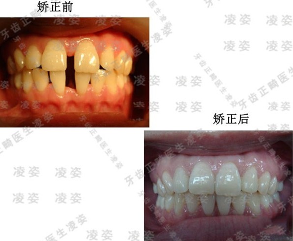 到上海圣貝口腔戴時(shí)代天使單膜,解決了4mm大的門牙牙縫問(wèn)題