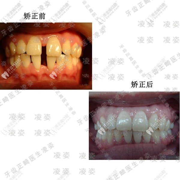 牙縫過(guò)大矯正前后效果圖
