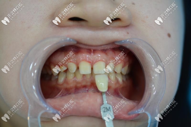 牙齒貼面比色，<!--<i data=20240703-sp></i>-->口腔