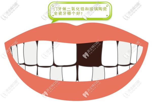 門牙做二氧化鋯和玻璃陶瓷全瓷牙哪個好