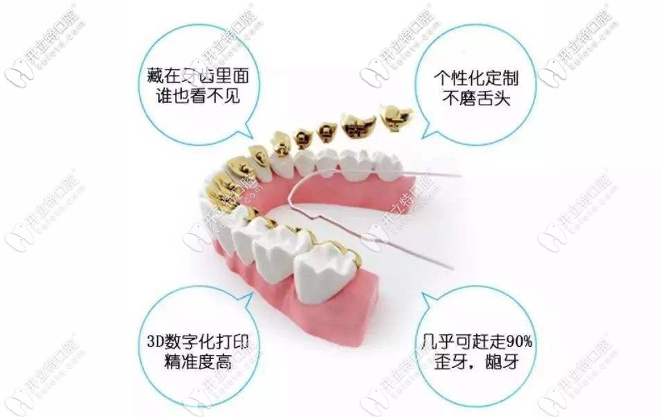 舌側(cè)隱形矯正優(yōu)勢(shì)圖