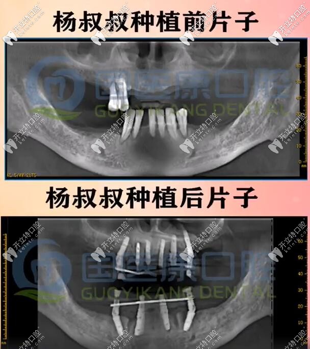 71歲楊叔做一日得全口種植牙種了10顆植體，上半口6下半口4