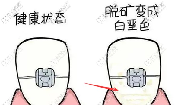 牙齒脫礦還能戴牙套矯正嗎?預(yù)防正畸脫礦的治療方法請(qǐng)收好