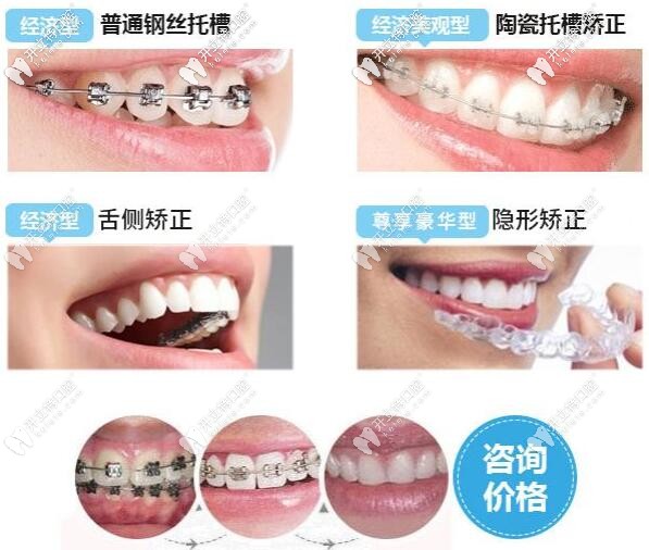 矯治器類(lèi)型