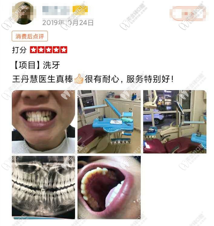 洗牙前后對比圖