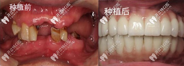 全口種牙后