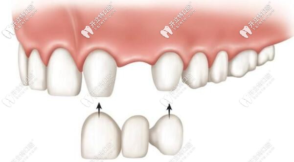 固定義齒修復(fù)