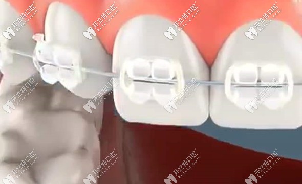 3M陶瓷自鎖托槽的價(jià)格...