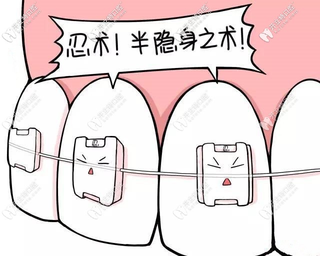 透明陶瓷矯正牙套