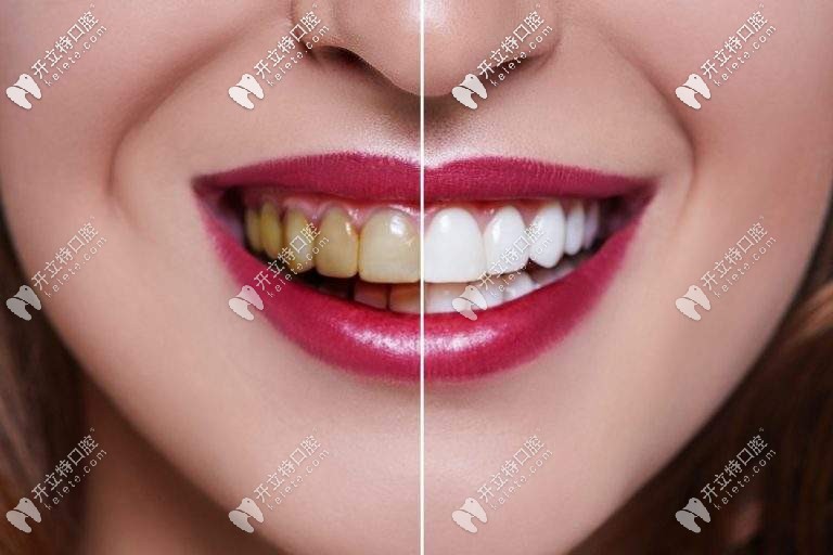 實(shí)錘|在沈陽(yáng)做牙齒貼面5年沒后悔,快看這瓷貼面圖片和過程