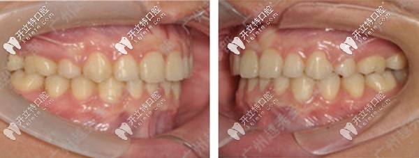 將自己的齙牙交付給廣州越秀區(qū)圣貝牙科的熊飛醫(yī)生