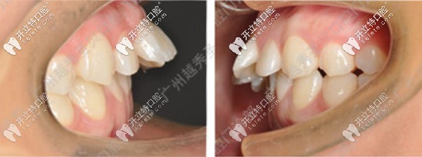 小哥哥在廣州越秀區(qū)整牙前的牙齒照