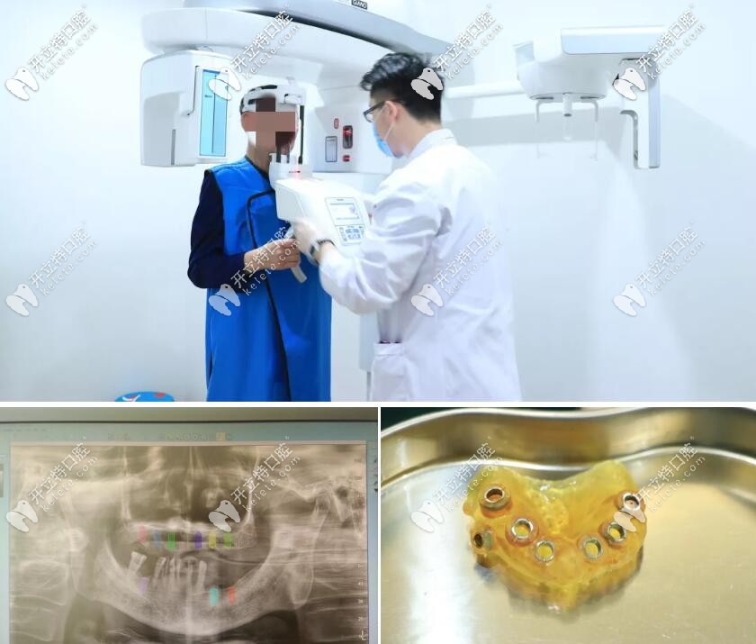 張大爺種牙前的CBCT檢查和3D數(shù)字化導板