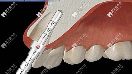 即刻種植對(duì)骨量是有一定要求的