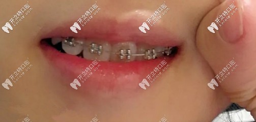 矯正虎牙多久能拉下來(lái)？我用了不到半年哦