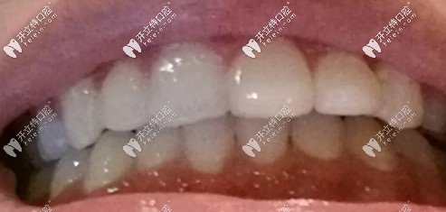 摘到牙套戴保持器，有點(diǎn)深覆合的人很漂亮哦