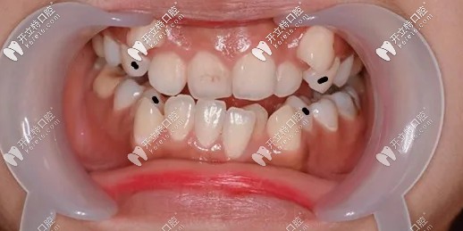 標(biāo)黑點(diǎn)的地方就是要拔掉的4顆4號(hào)牙