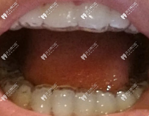 牙醫(yī)建議要佩戴1-2年的保持器